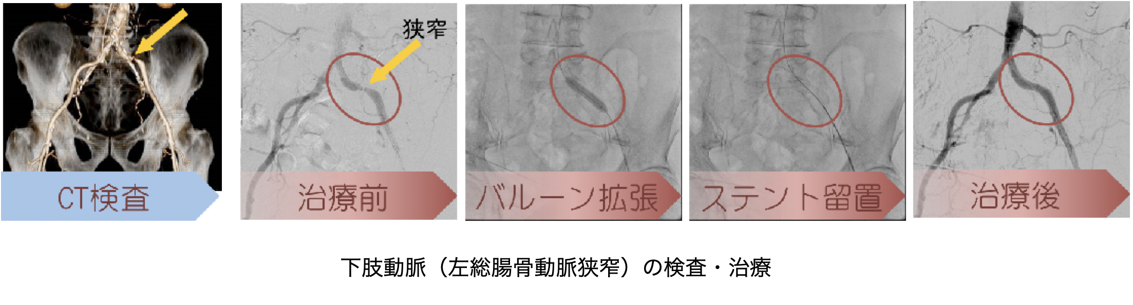 下肢動脈（左総腸骨動脈狭窄）の検査・治療（CT検査・治療前・バルーン拡張・ステント留置・治療後 写真）