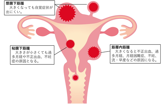 妊娠 中 子宮 筋腫