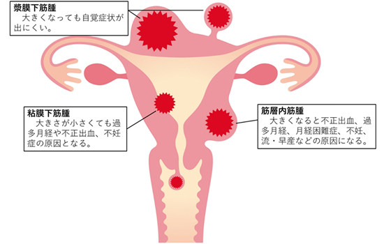 子宮 妊娠 筋腫 中 妊娠中ですが子宮筋腫があります!大丈夫ですか? 現役産婦人科医が教える!