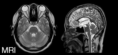 MRIの画像