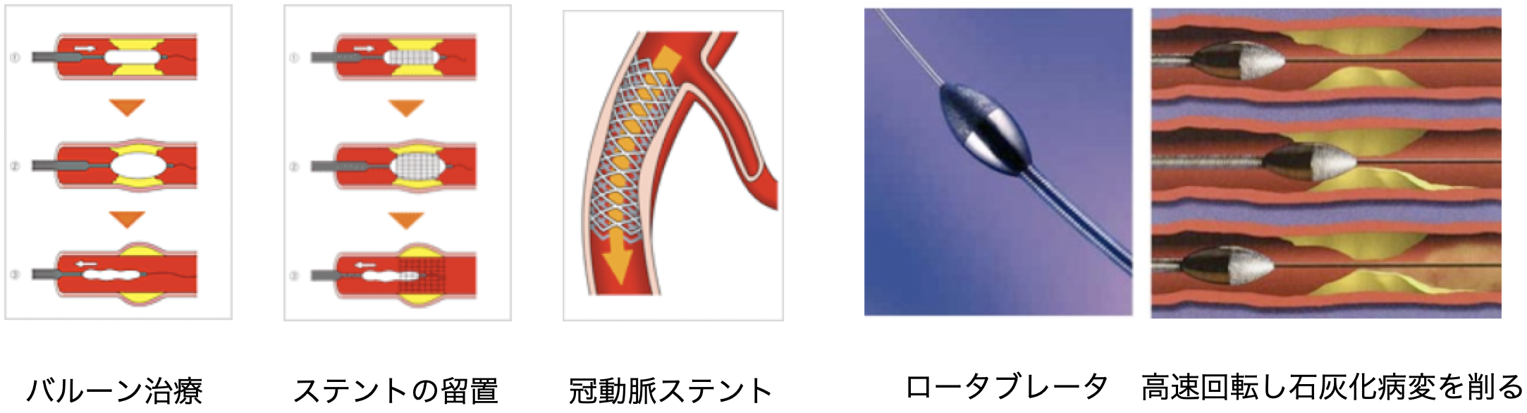 バルーン治療・ステントの留置・冠動脈ステント・ロータブレータ（高速回転し石灰化病変を削る）図版